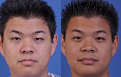 before and after orthognathic surgery male patient front view case 2562