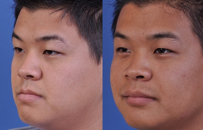 before and after orthognathic surgery male patient left angle view case 2562