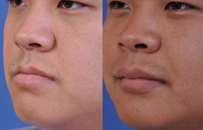 before and after orthognathic surgery male patient left angle view case 2562