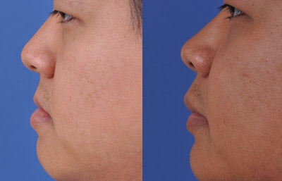 before and after orthognathic surgery male patient left side view case 2562