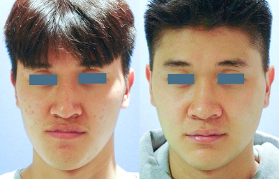 before and after orthognathic surgery male patient front view case 2569