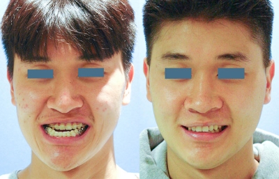 before and after orthognathic surgery male patient front view case 2569