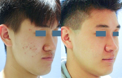 before and after orthognathic surgery male patient right angle view case 2569