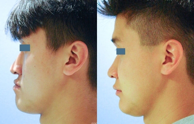 before and after orthognathic surgery male patient left side view case 2569