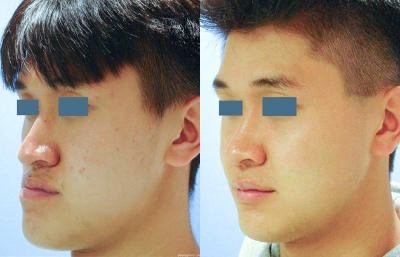 before and after orthognathic surgery male patient left angle view case 2569