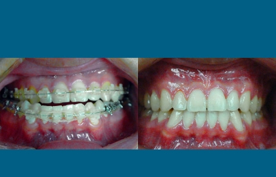 before and after orthognathic surgery front view case 2569