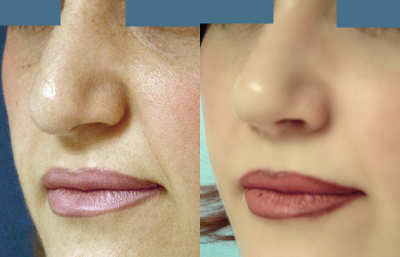 before and after revision rhinoplasty female patient left angle view case 2271