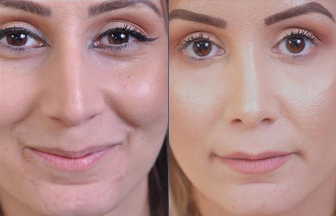 before and after rhinoplasty female patient front view case 2055