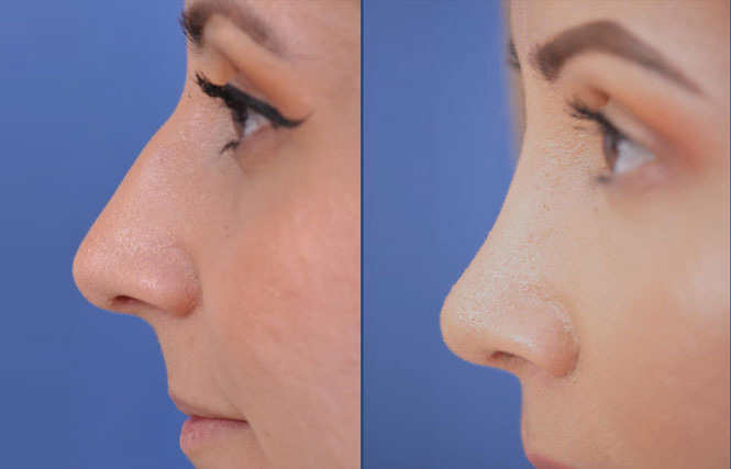before and after rhinoplasty female patient left side view case 2055