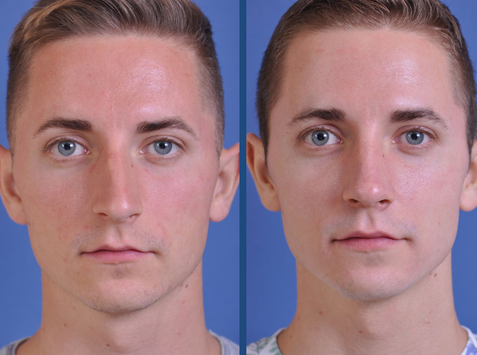 before and after rhinoplasty male patient front view case 2078