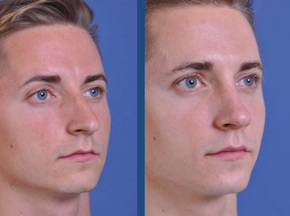 before and after rhinoplasty male patient right angle view case 2078