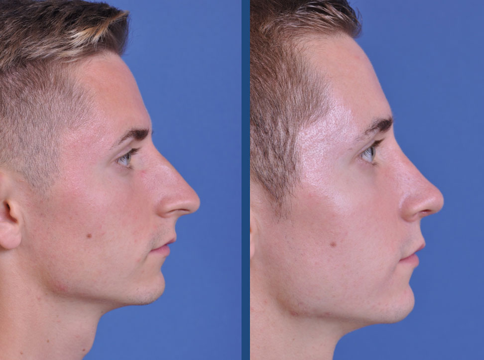 before and after rhinoplasty male patient right side view case 2078