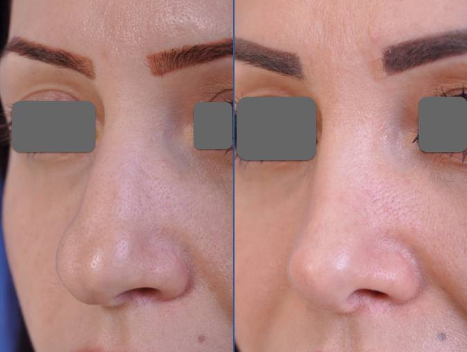 before and after rhinoplasty female patient left angle view case 2088