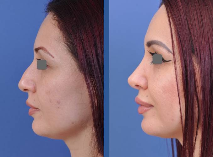 before and after rhinoplasty female patient left side view case 2088