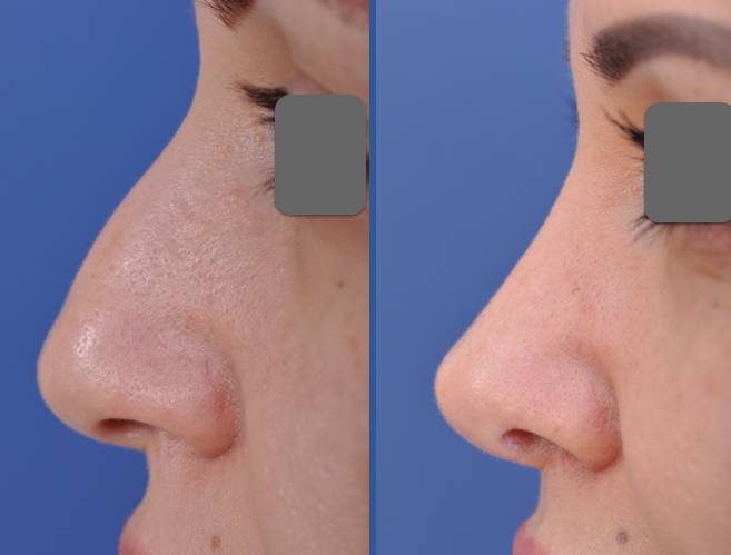 before and after rhinoplasty female patient left side view case 2088