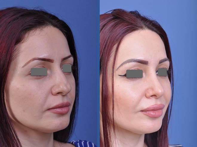 before and after rhinoplasty female patient right angle view case 2088