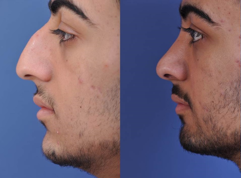 before and after rhinoplasty male patient left side view case 2098