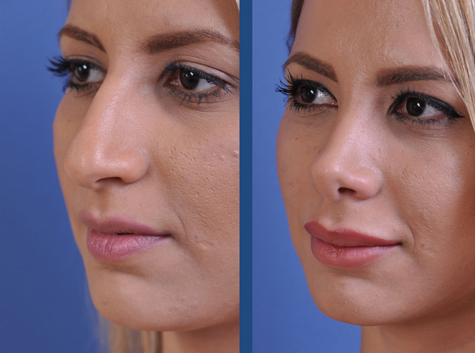 before and after rhinoplasty female patient left angle view case 2119