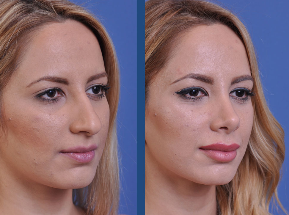 before and after rhinoplasty female patient right angle view case 2119