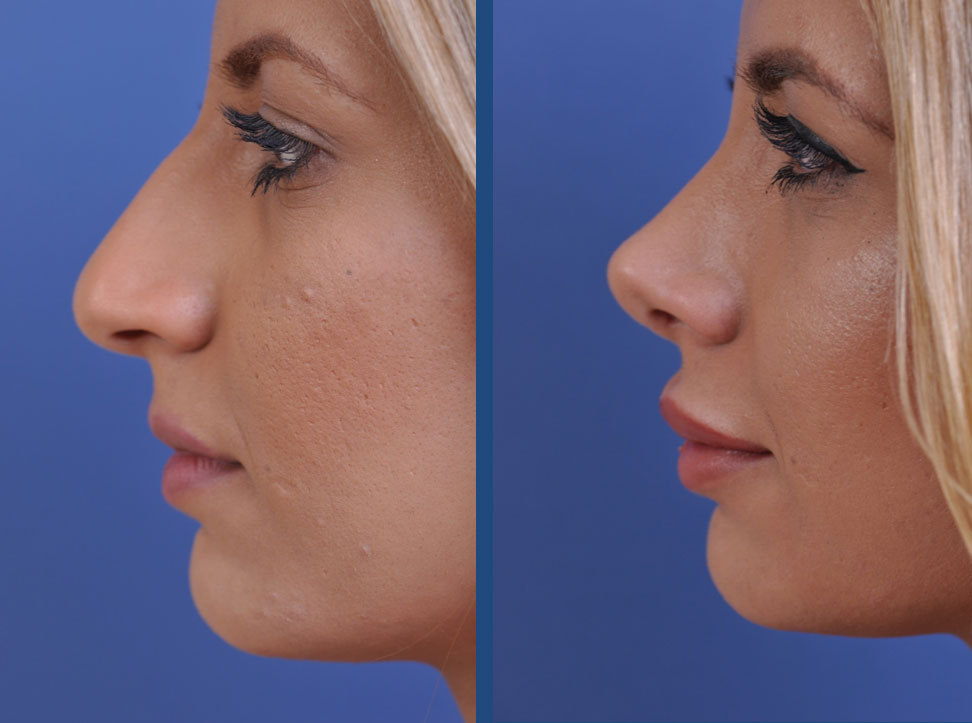 before and after rhinoplasty female patient left side view case 2119