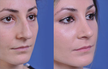 before and after rhinoplasty female patient right angle view case 2139