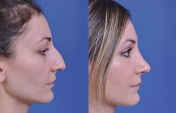 before and after rhinoplasty female patient right side view case 2139