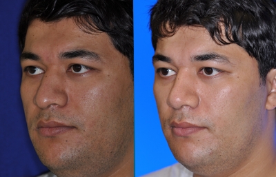before and after rhinoplasty male patient left angle view case 2212