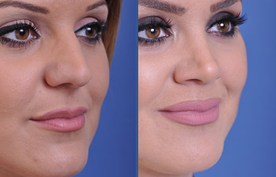 before and after rhinoplasty female patient right angle view case 2247