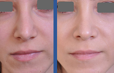 before and after rhinoplasty female patient front view case 2253