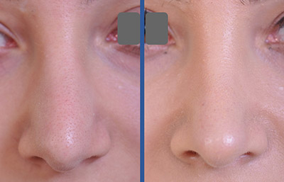 before and after rhinoplasty closeup front view case 2253