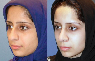 before and after rhinoplasty female patient left angle view case 2265