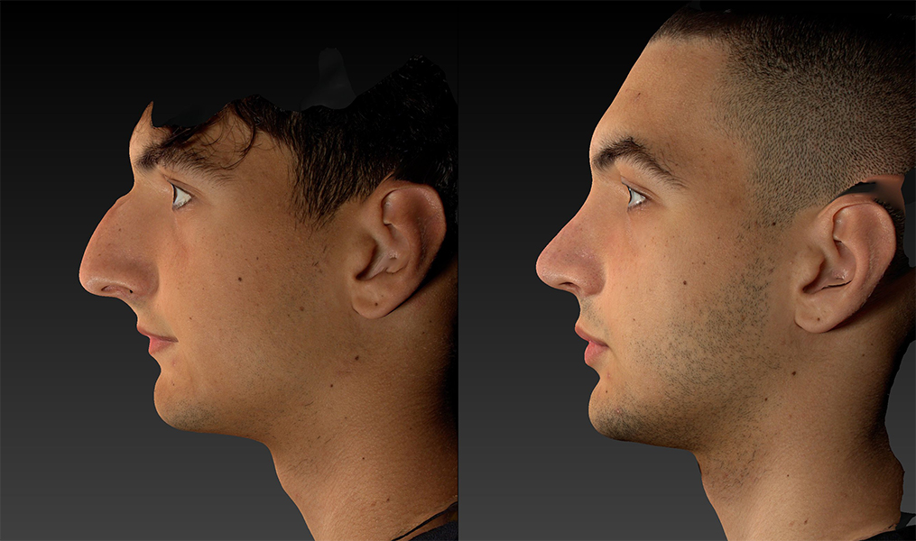 before and after rhinoplasty male patient left side view case 3153