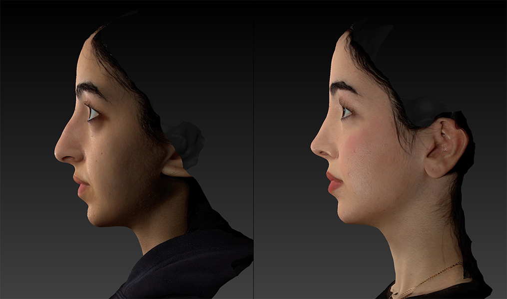 before and after rhinoplasty female patient left side view case 3052