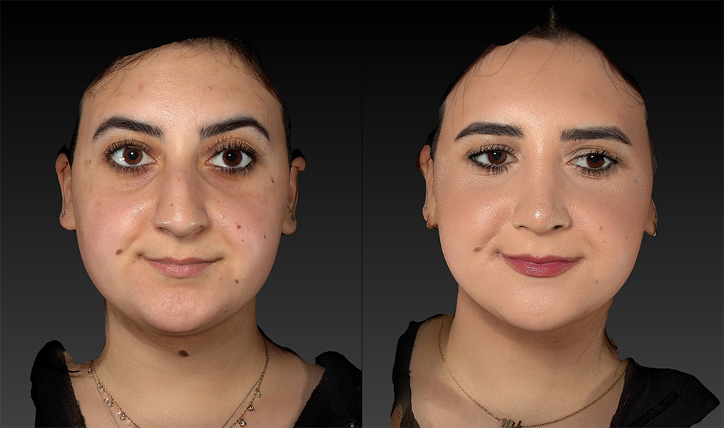before and after rhinoplasty front view female patient case 3643
