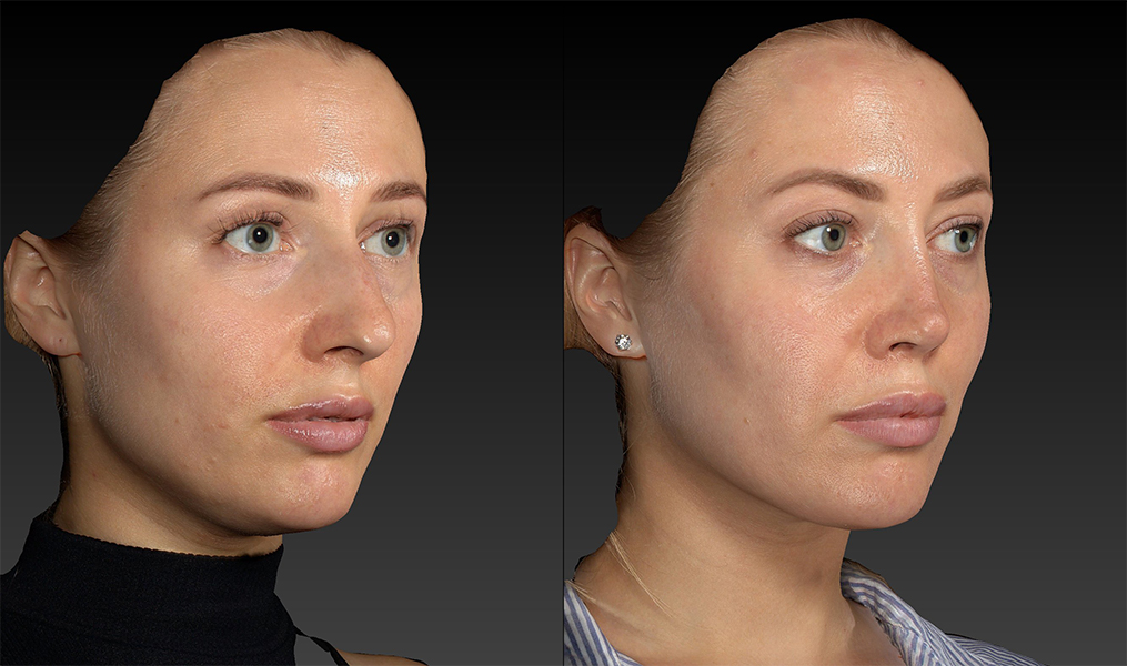 before and after rhinoplasty female patient right angle view case 3423