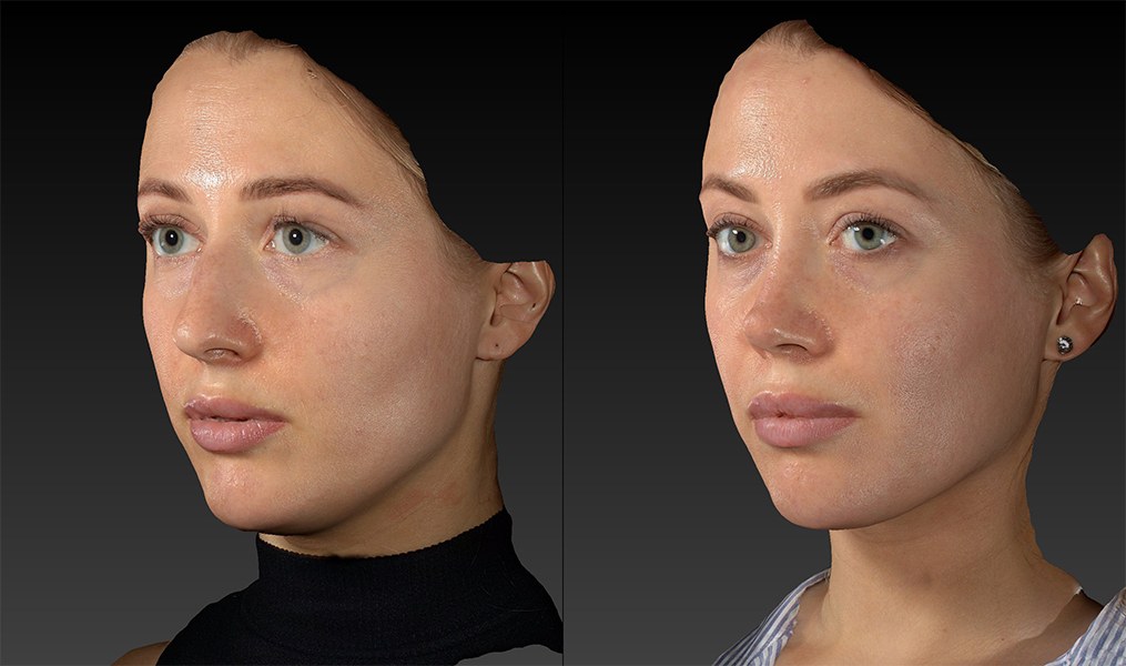 before and after rhinoplasty female patient left angle view case 3423