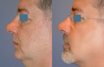 before and after neck liposuction left side view male patient case 3500