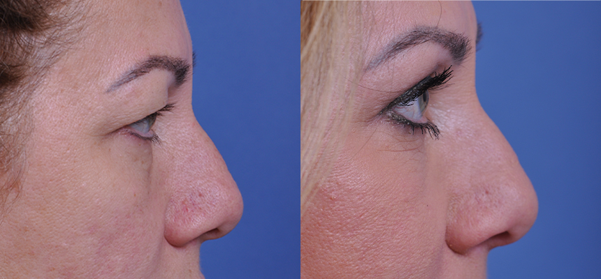 before and after blepharoplasty right side view female patient case 4861