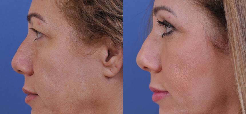 before and after blepharoplasty left side view female patient case 4861