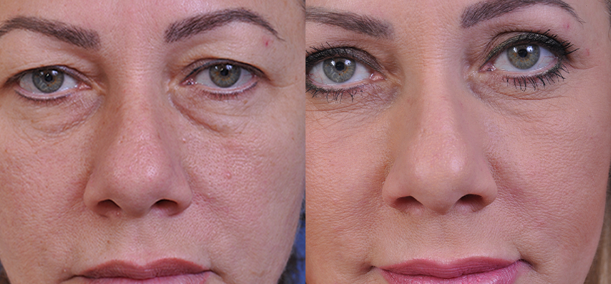before and after blepharoplasty front view female patient case 4861