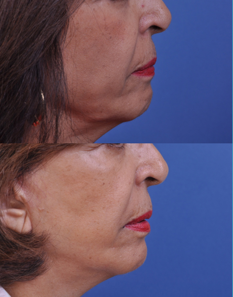 before and after chin augmentation right side view female patient case 5009