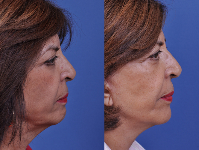 before and after neck lift right side view female patient case 5019
