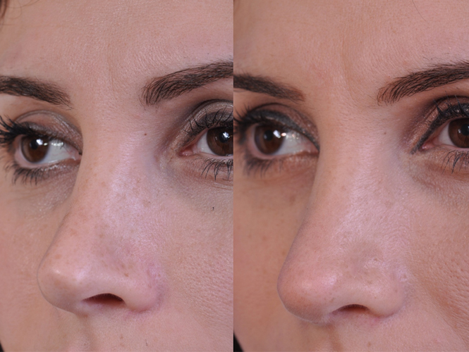 before and after revision rhinoplasty left angle closeup view female patient case 4943
