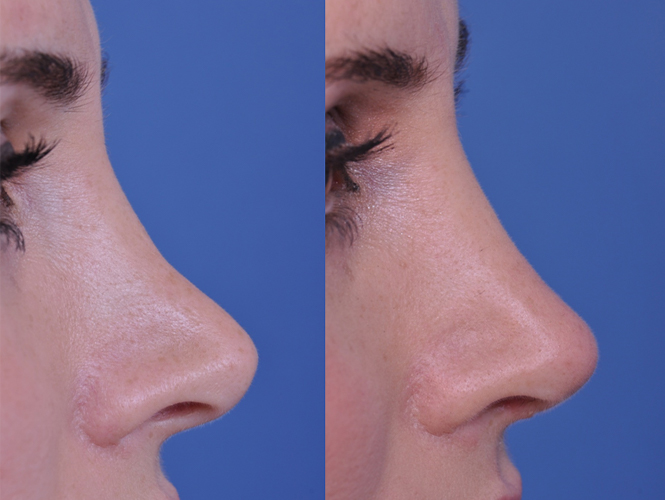 before and after revision rhinoplasty right side closeup view female patient case 4943