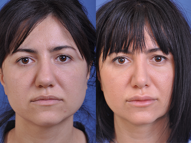 before and after rhinoplasty female patient front view case 4829