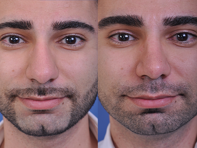before and after rhinoplasty male patient front closeup view case 4845