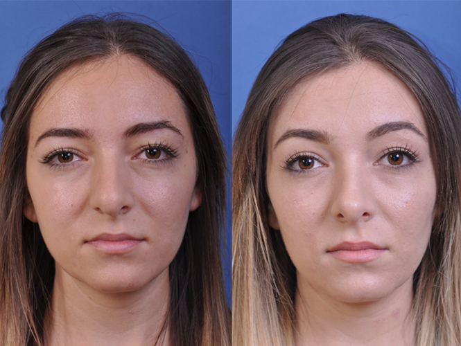 before and after rhinoplasty front view female patient case 4953