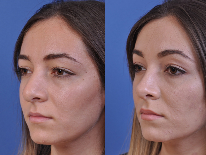 before and after rhinoplasty left angle view female patient case 4953