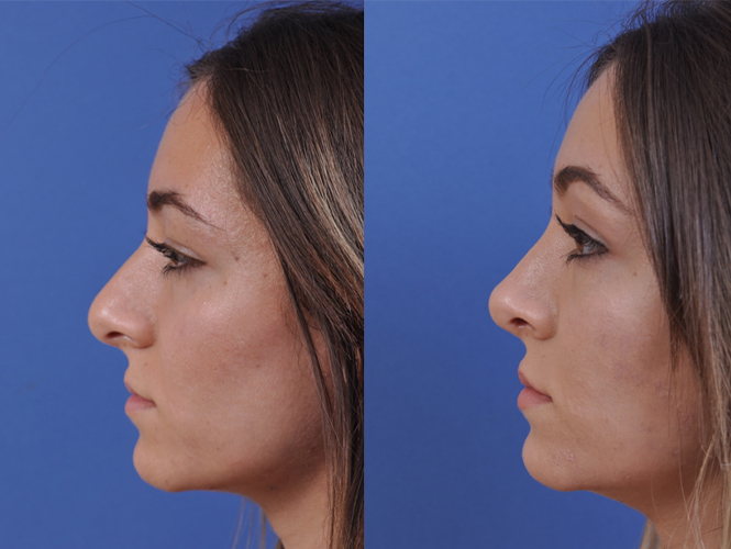 before and after rhinoplasty left side view female patient case 4953
