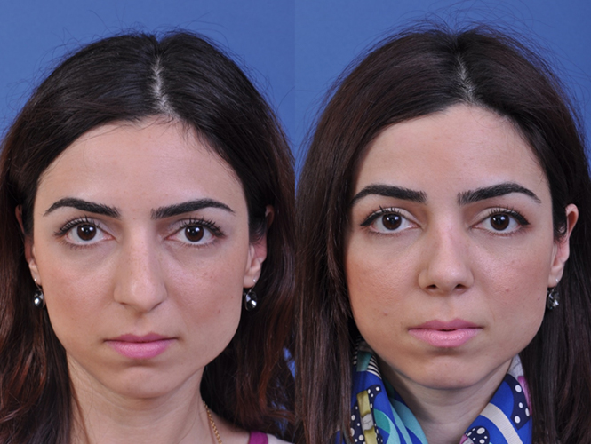 before and after rhinoplasty front view female patient case 4968